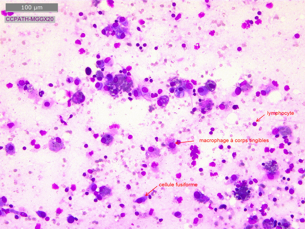 Examen cytologique en faveur d’une panniculite granulomateuse