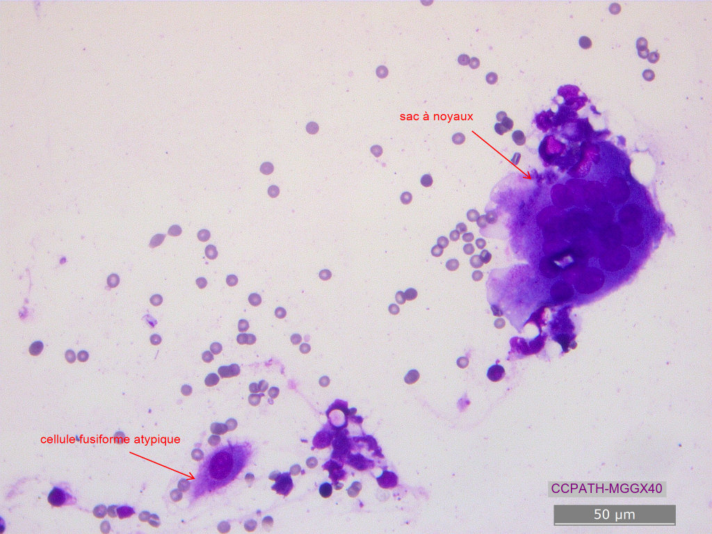 Examen cytologique en faveur d’un histiocytome fibreux malin, tumeur appartenant au complexe FSK félin
